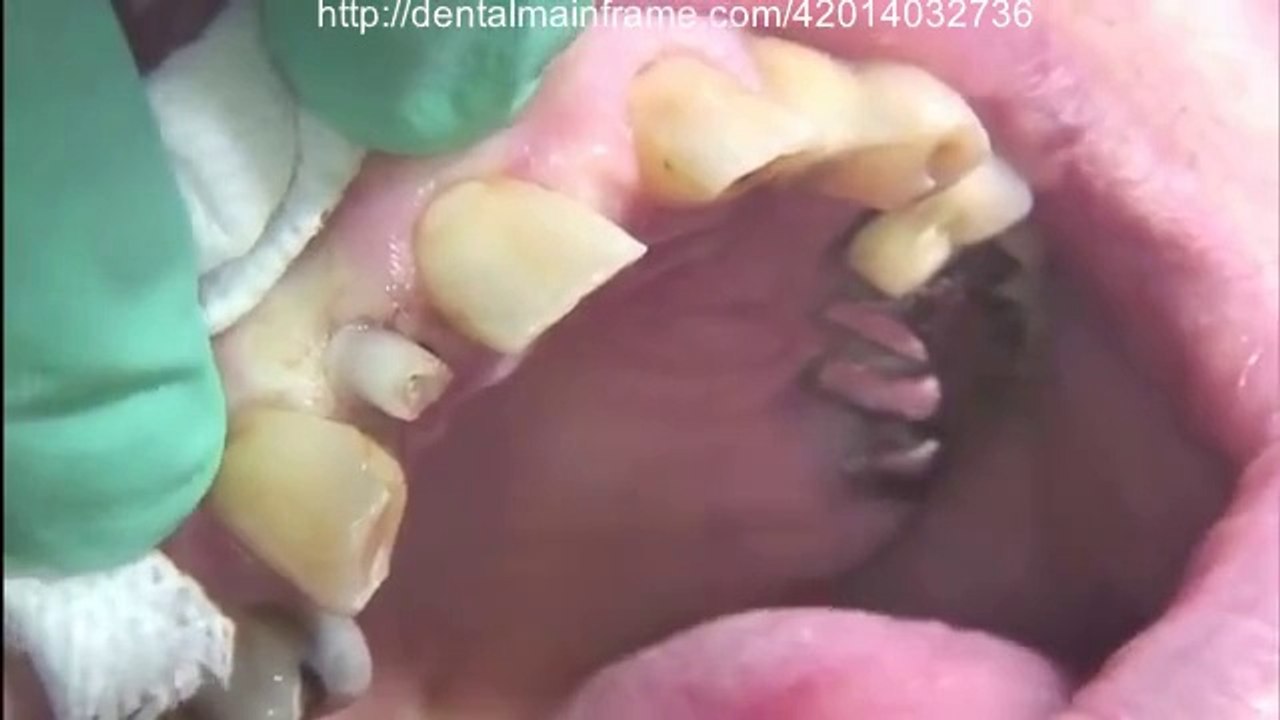 Mini Dental Implant for Replacement of Missing Tooth (Maxillary Lateral Incisor)