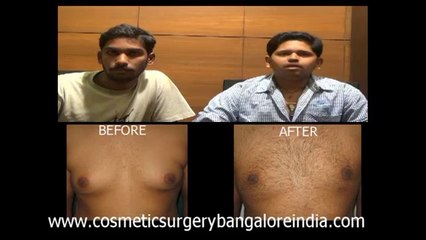 GYNECOMASTIA SUREGRY BANGALORE: Dr. M.S. Venkatesh