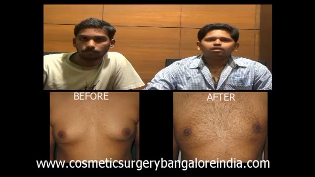 GYNECOMASTIA SUREGRY BANGALORE: Dr. M.S. Venkatesh