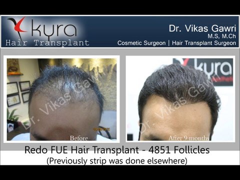 Hair transplant in Ludhiana, Punjab, India, Jalandhar, Amritsar