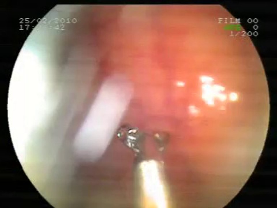 Kolon kanseri belirtileri nedir? Kolon kanseri öldürür mü? Kolon kanseri evreleri   Kolon kanseri olanların yorumlari