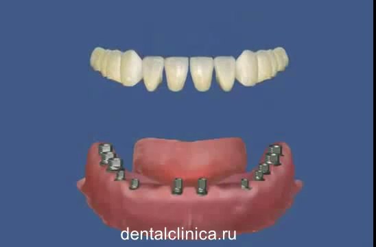 European Clinic of Aesthetic Dentistry Стоматология лечение зубов в Санкт-Петербурге Москве имплантация европейское качество низкие цены протезирование туризм путешествия отдых