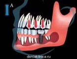 Стоматология лечение зубов в European Clinic of Aesthetic Dentistry in Budapest “Jewel Dental” “AVANTE”  имплантация европейское качество низкие цены протезирование