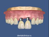 Стоматология лечение зубов в European Clinic of Aesthetic Dentistry in Budapest “Jewel Dental” “AVANTE” имплантация европейское качество низкие цены протезирование