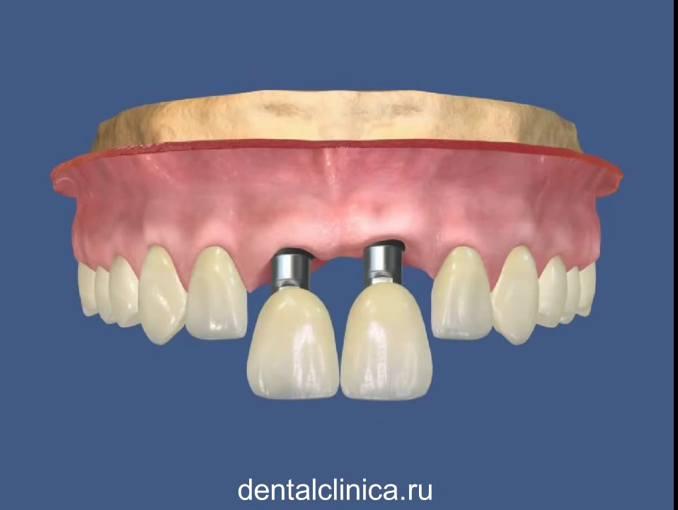 Стоматология лечение зубов в European Clinic of Aesthetic Dentistry in Budapest “Jewel Dental” “AVANTE” имплантация европейское качество низкие цены протезирование