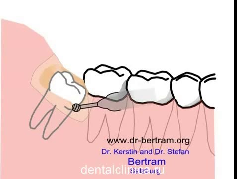 European Clinic of Aesthetic Dentistry in Budapest “Jewel Dental” “AVANTE” dental treatment prosthesis implantation plastic surgery Express therapy filling bone healing tourism health leisure