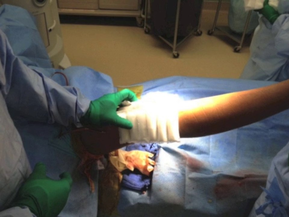 ALKANTIS (Total knee replacement)