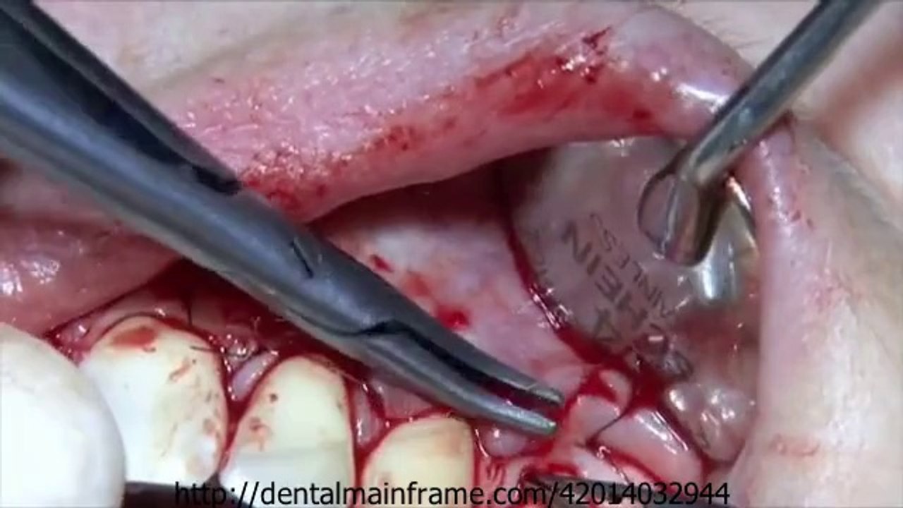 CORONALLY REPOSITIONED FLAP WITH CONNECTIVE TISSUE GRAFT