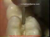 THE AMALGAM PROXIMAL BOX CAVITY PREPARATION