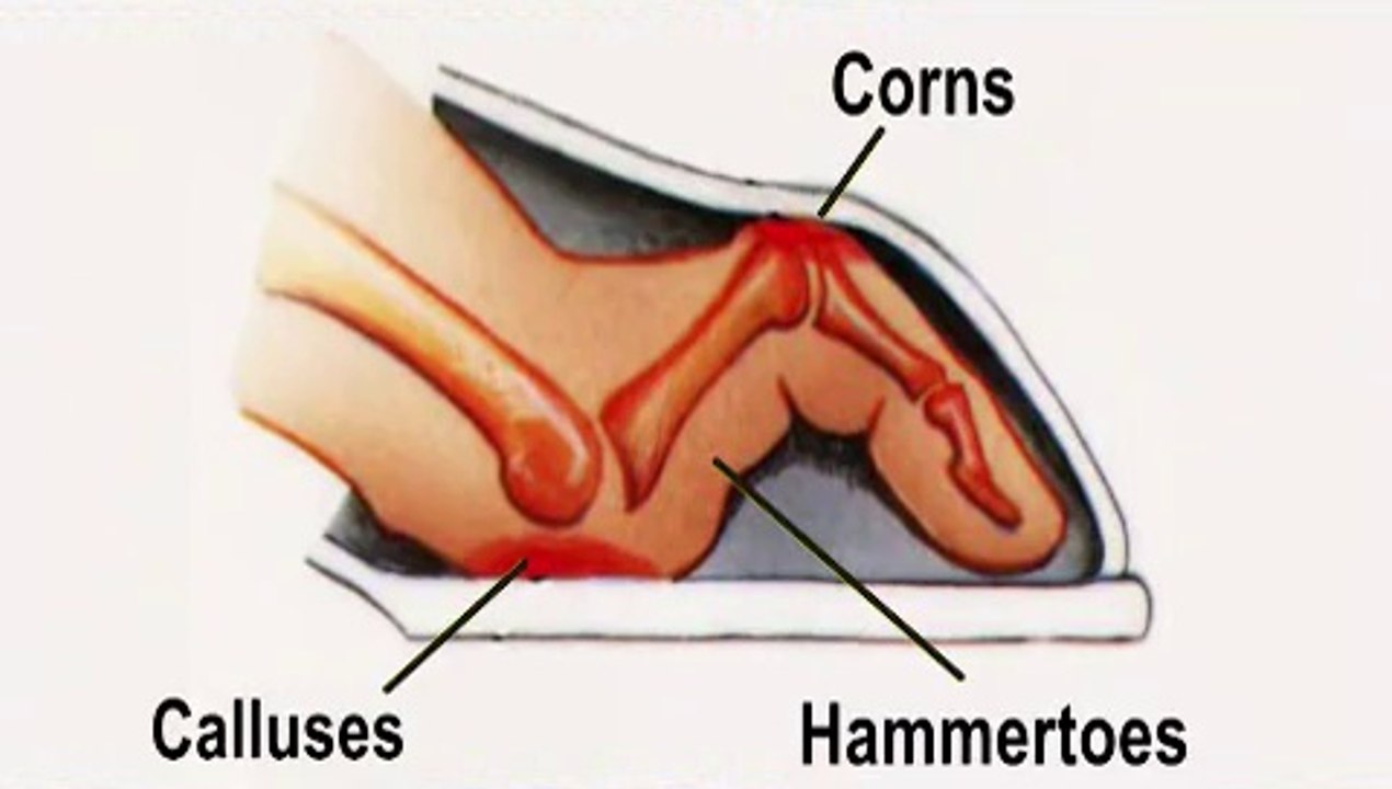 Hammertoes and Corns - Podiatrist in Richardson and Garland, TX – Gene Reister, DPM