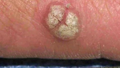 Foot Warts (Plantar Warts) - Podiatrist in Richardson and Garland, TX – Gene Reister, DPM