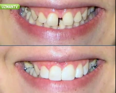 Gülüş estetiği ne anlama gelir?