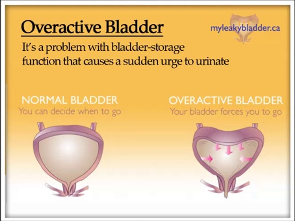 Overactive blabber Overactive Bladder Symptoms Overactive Bladder