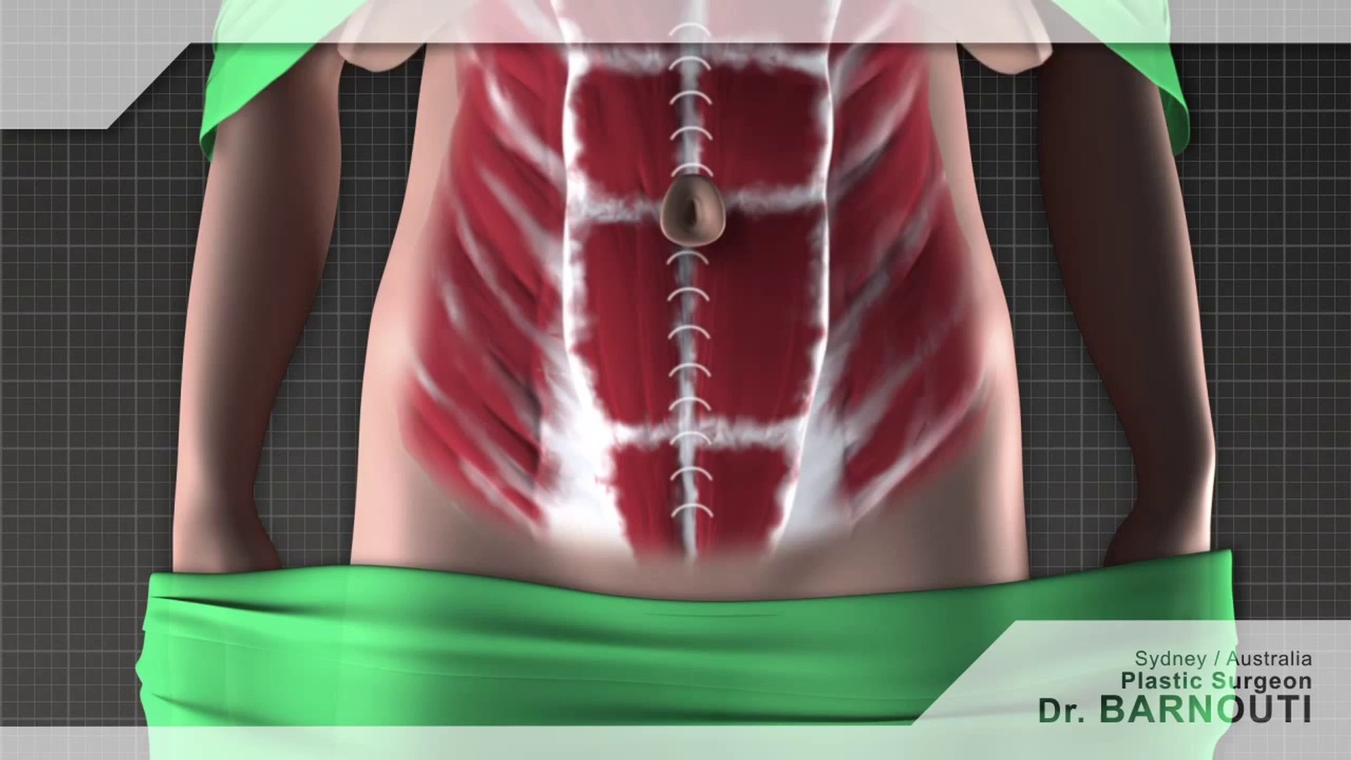 Abdominoplasty: Tummy Plastic Surgery Sydney