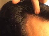 HAIR TRANSPLANT CLOSEUP: DR. SAMUEL LAM