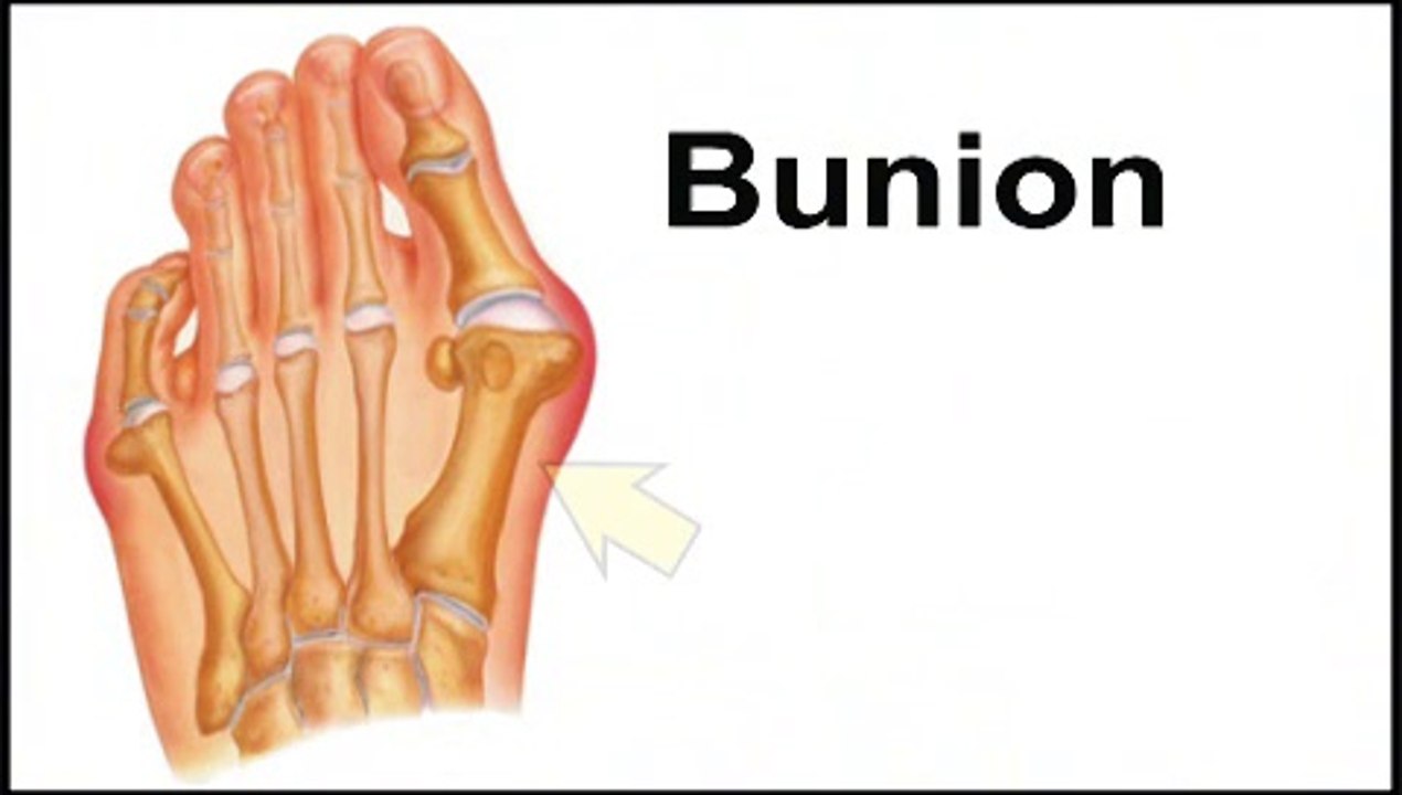Saginaw, Bay City and Essexville, MI  - Bunions - Podiatrist Andrew Cohen