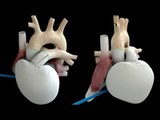 First artificial heart implant offers new hope to patients with heart diseases