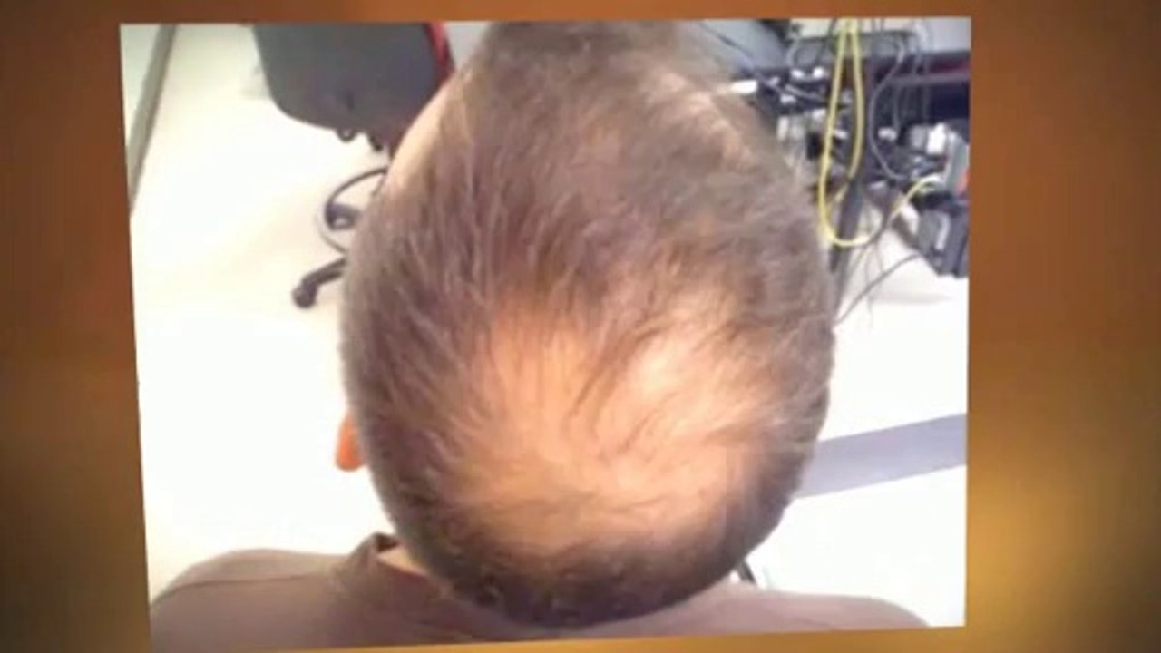 How to Stop a Receding Hairline