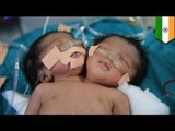 Conjoined twins born with two heads and one body die in India