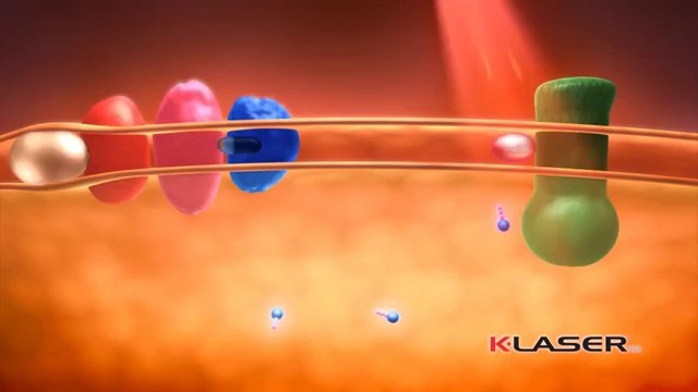 K Laser- How it works-Michael Berry,D.C.-Orange CA 92867- Orange County Chiropractor
