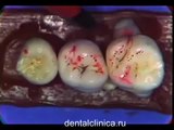 Лекция по Стоматологии анатомия моляров, лечение зубов, видео семинар