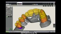 Лечение зубов, CAD моделирование, 3D принтер, протезирование на имплантах European Clinic of Aesthetic Dentistry in Budapest “Jewel Dental” “AVANTE”