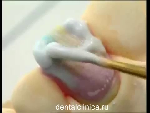 Клиника Имплантологии и Эстетической Стоматологии Презентация Hi-Tech Carat Keramik German Эстетическая стоматология протезирование