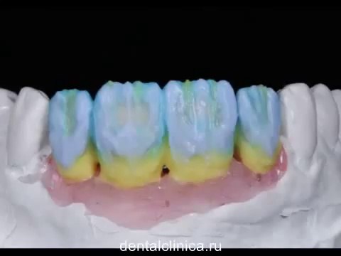 Международная клиника имплантологии и протезирования Презентация красивой улыбки Керамика металлокерамика коронки зубов Протезирование