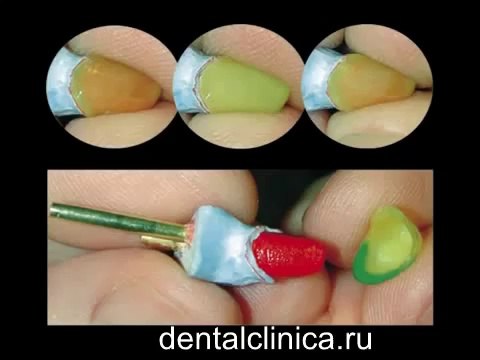 Клиника Имплантологии и Эстетической Стоматологии Протезирование hi-tech Galileo Waxes Лечение зубов European Clinic of Aesthetic Dentistry