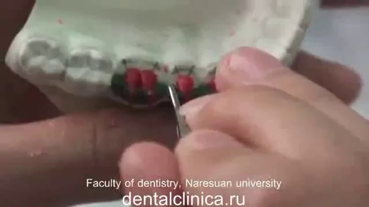 Клиника Имплантологии и Эстетической Стоматологии Протезирование Mandibular posterior teeth Лечение зубов в Клинике эстетической стоматологии