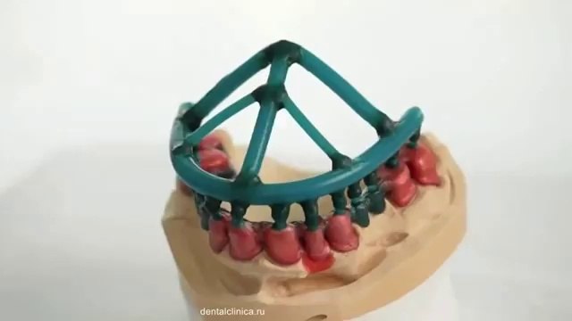 Клиника Имплантологии и Эстетической Стоматологии Протезирование лечение зубов в Будапеште Dental Lab Telescopic European Clinic Dentistry