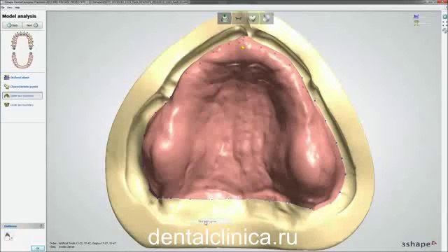 Протезирование, полный съёмный протез, 3D дизайн система в стоматологии Международная клиника имплантологии и протезирования