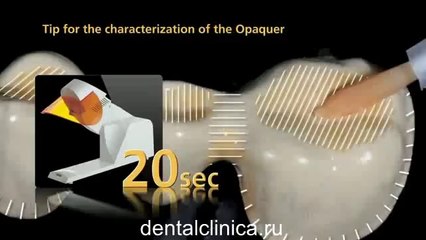 Реставрационная стоматология, протезирование SR Nexco система металлокерамика Клиника Имплантологии и Эстетической Стоматологии
