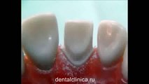Стоматология семинар Изготовление керамической коронки зуба, подготовка основания, видео урок Международная клиника стоматологии имплантологии