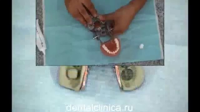 European Clinic of Aesthetic Dentistry in Budapest “Jewel Dental” “AVANTE” Dentist Medical Center Международная клиника имплантологии и протезирования Семинар Коронки циркониевые, металлокерамика, керамика Профессиональная стоматология