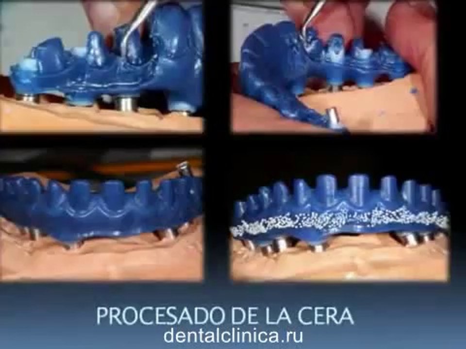Семинар Протезирование металлокерамикой, коронки из циркония Профессиональная стоматология European Clinic of Aesthetic Dentistry in Budapest “Jewel Dental” “AVANTE”