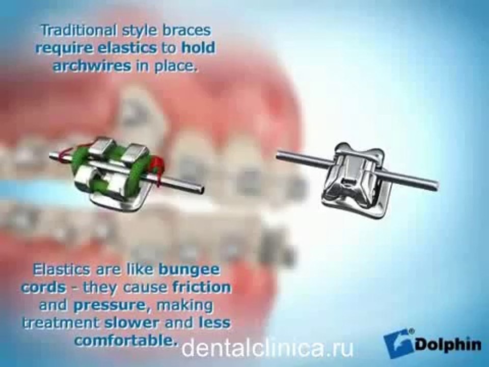 European Clinic of Aesthetic Dentistry in Budapest “Jewel Dental” “AVANTE” Стоматология ортодонтия hi-tech Damon System Красивая улыбка приятные цены хорошее настроение Международная клиника стоматологии имплантологии