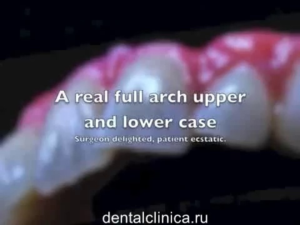 European Clinic  Dentistry in Budapest Jewel Dental AVANTE Dentist Medical Center Эстетическая дентальная реставрация, процедура восстановления арки, имплантация видео урок Центр Имплантологии и Ресторативной Стоматологии