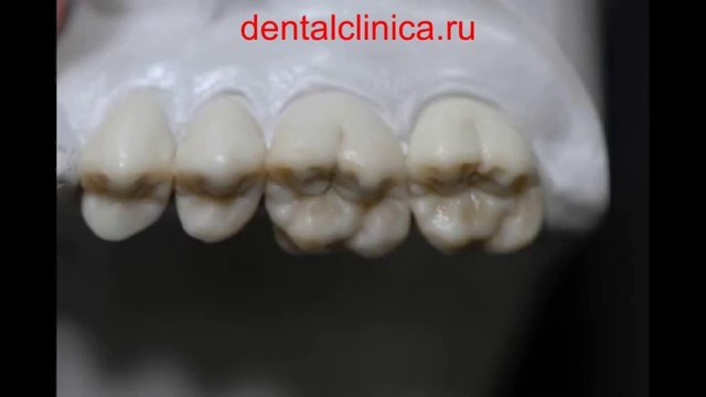 European Clinic Dentistry in Budapest Jewel Dental AVANTE Dentist Medical Center Эстетическая реконструктивная стоматология, доступные цены отзывы пациентов, улыбки на лицах Клиника Имплантологии и Эстетической Стоматологии
