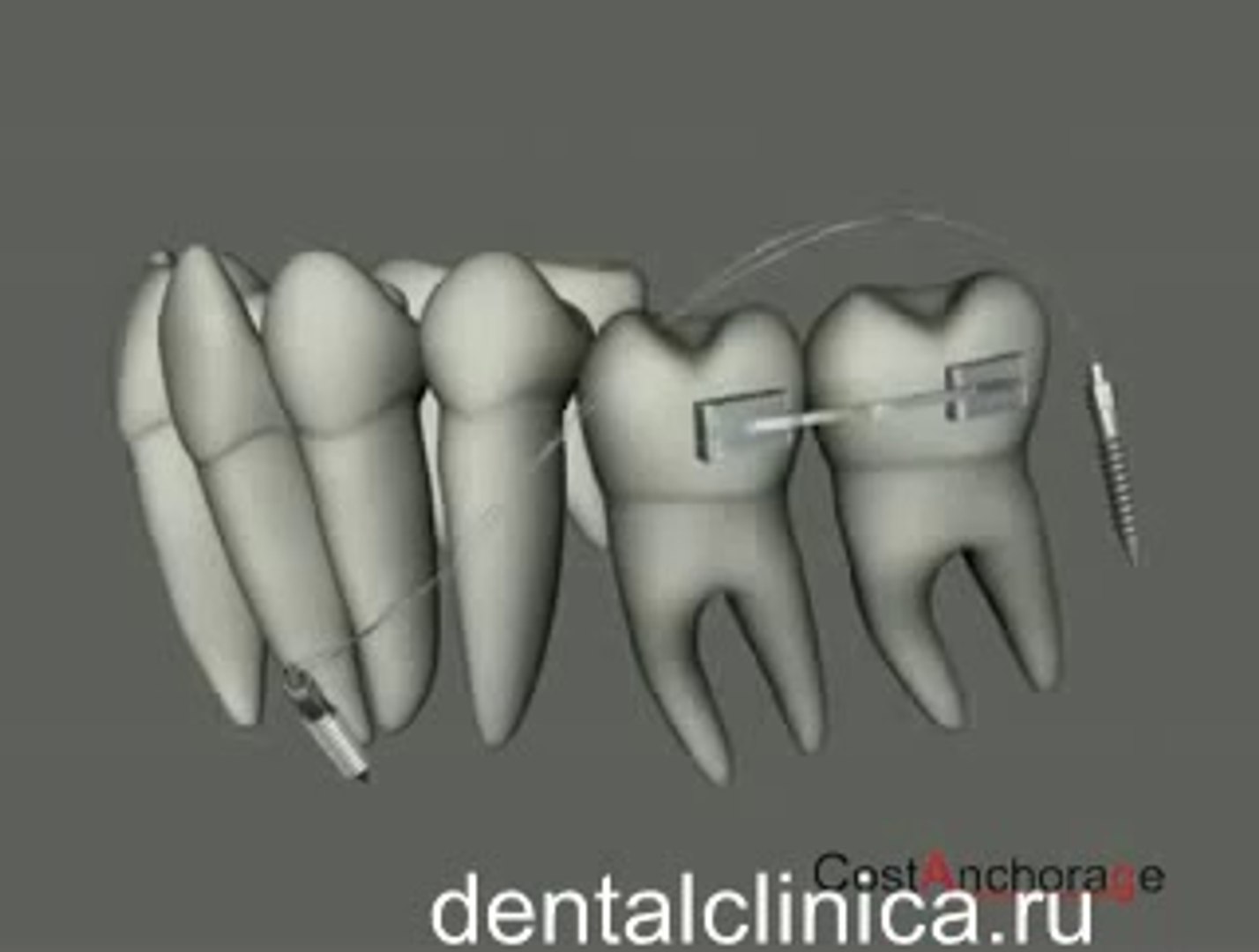 ⁣European Clinic  Dentistry in Budapest Jewel Dental AVANTE Dentist Medical Center Эстетическая стома