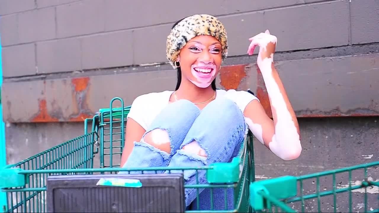 Chantelle Winnie Vitiligo