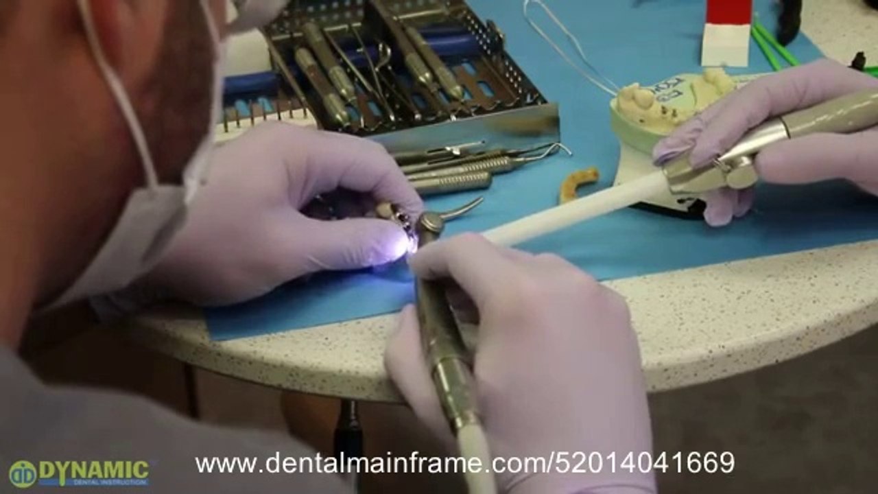 Cementation of PFM Bridge #8-13 on Mini Dental Implants_(new)
