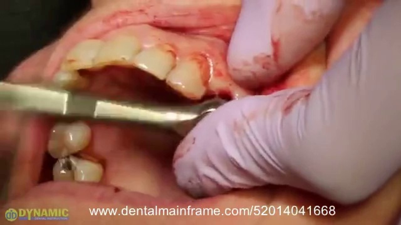 Immediate Extraction # 12 & 13 Placement of Mini Dental Implants for Fixed Crowns_(new)
