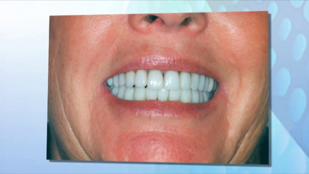 Root canals & Chipped teeth - Lakewood NJ Family Dental