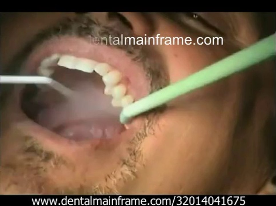 Mini Dental Implants - Single Tooth Replacement - Dr. Todd E. Shatkin_(new)
