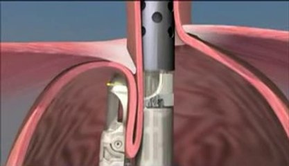 Lung Biopsy Los Angeles