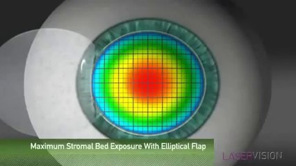 Bir İnci Göz - IntraLASIK™