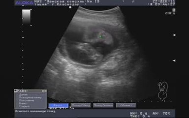 Плод на 23 неделе беременности