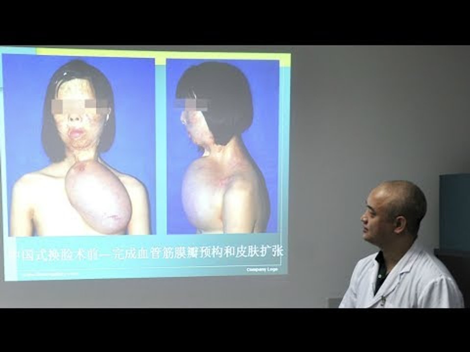 Chinese burn victim gets face transplant using tissue from her chest - video Dailymotion