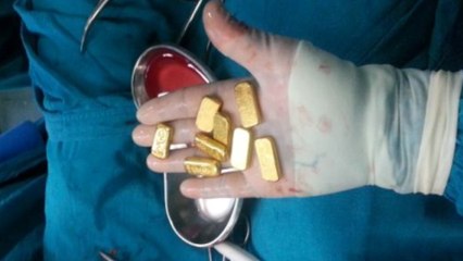 12 Gold Bars Discovered in Man's Stomach
